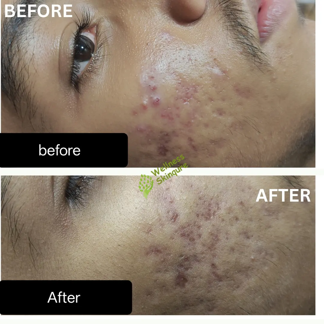 Before After Result